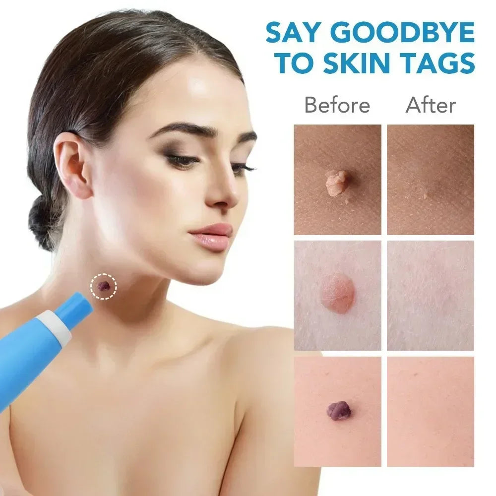 NEW Skin Tags Remover Tool 2-in-1 Auto Fast Removal Kit Safe Auto Tags Removal Pen with Bands 2-8mm Skin Tag Face Skin Care Tool